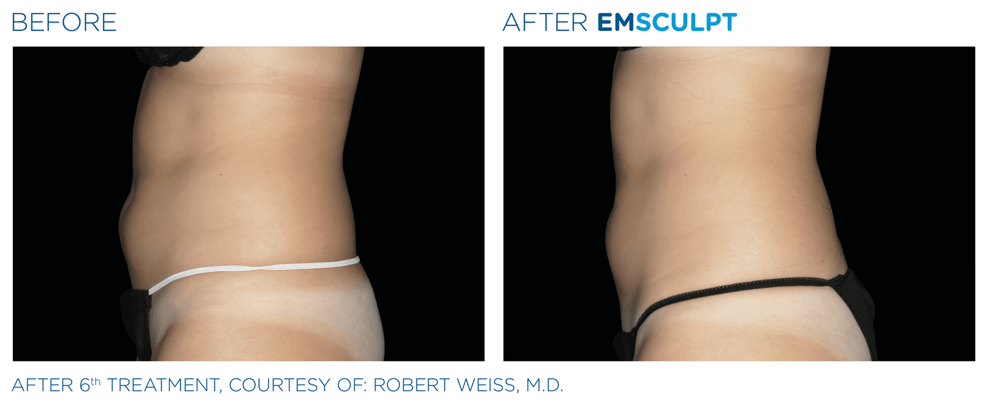 Emsculpt abdomen results - before and after
