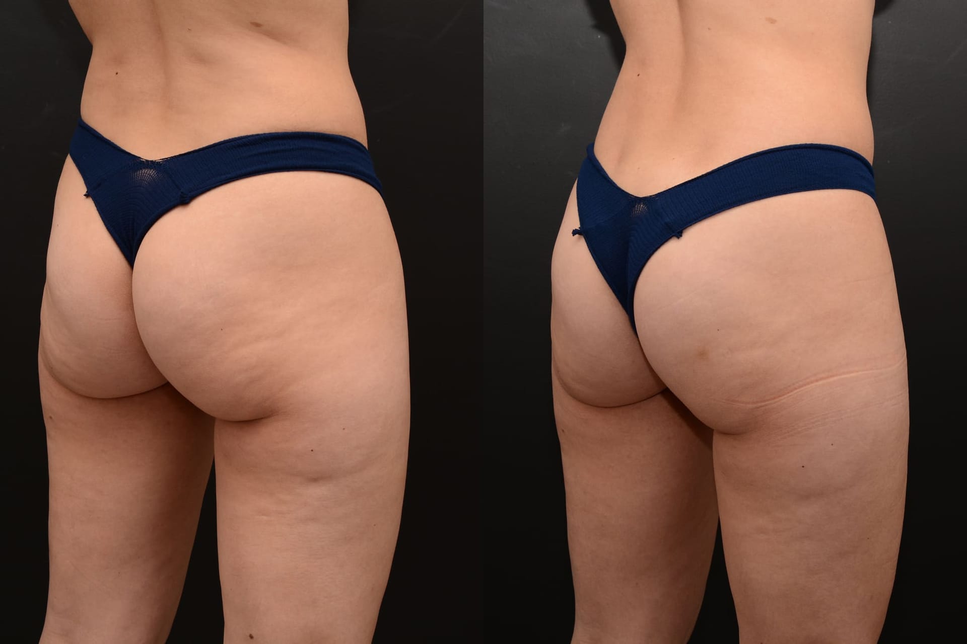 Emsculpt buttocks enhancement after 4 treatments - before and after
