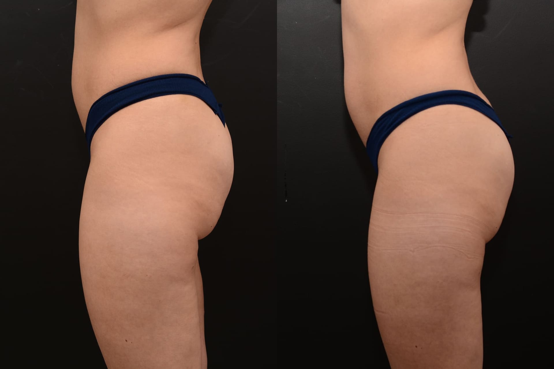 Emsculpt buttocks enhancement after 4 treatments - before and after