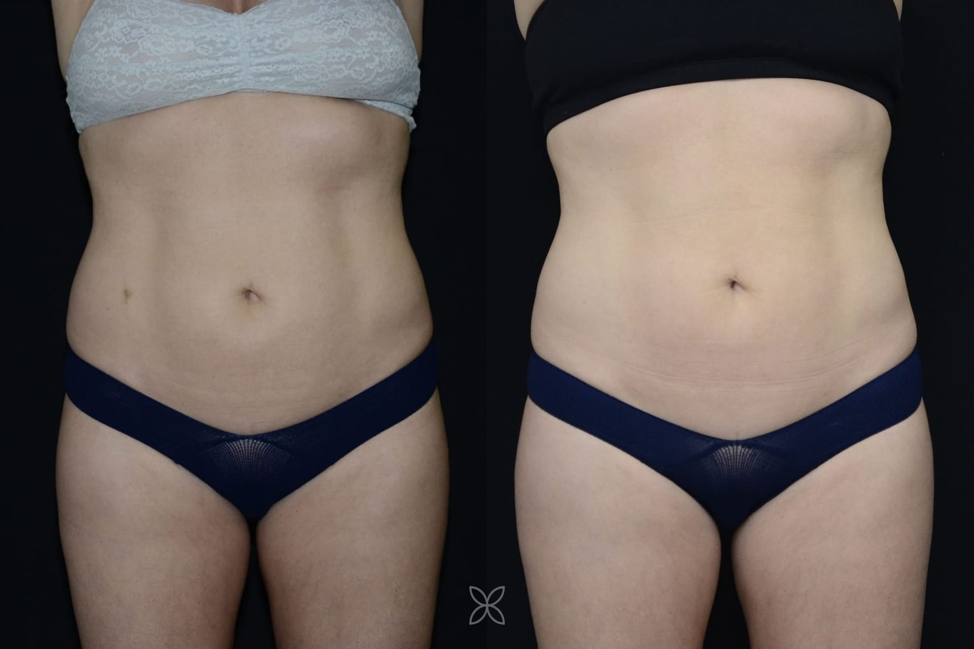 Emsculpt abdomen results - before and after