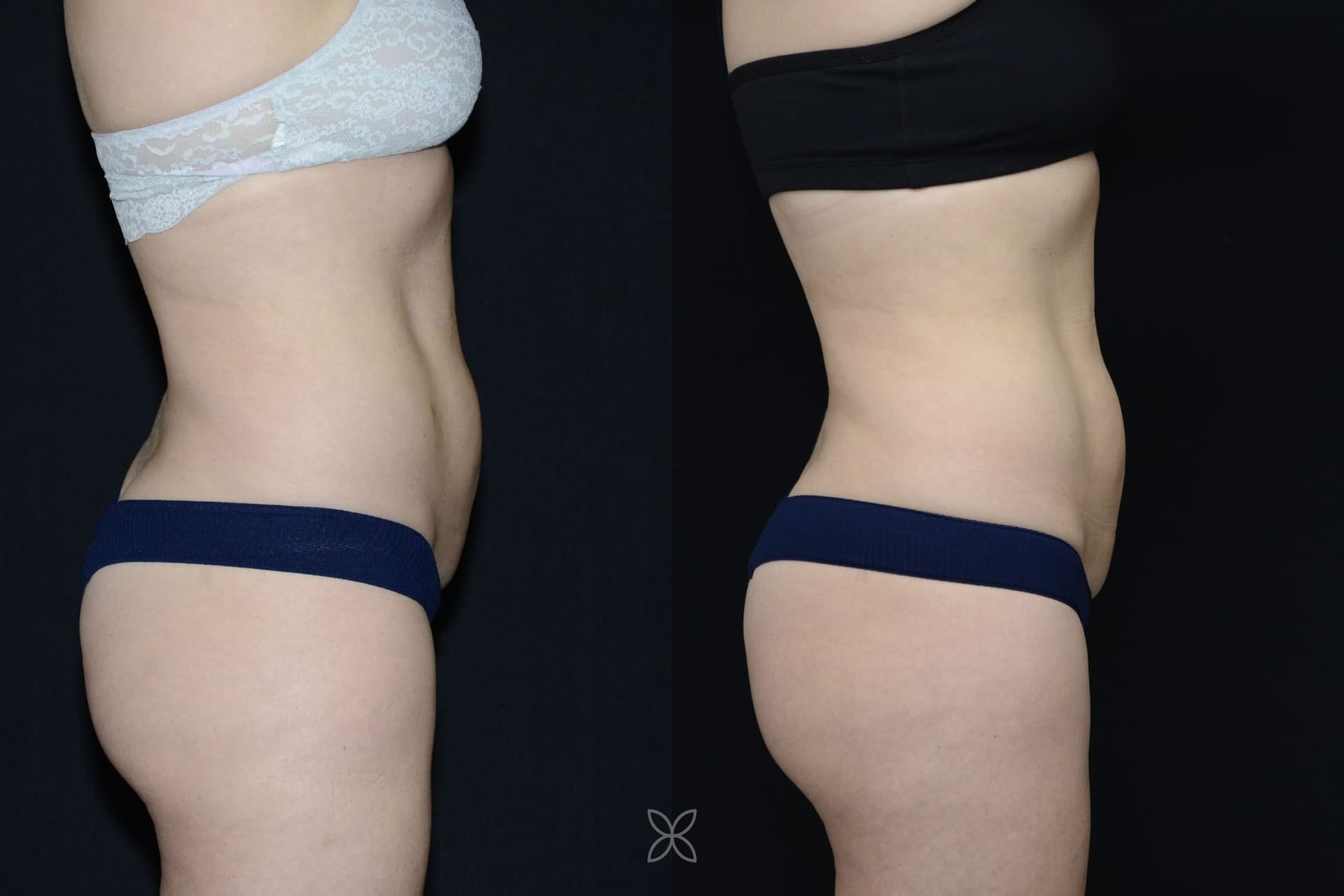 Emsculpt abdomen results - before and after