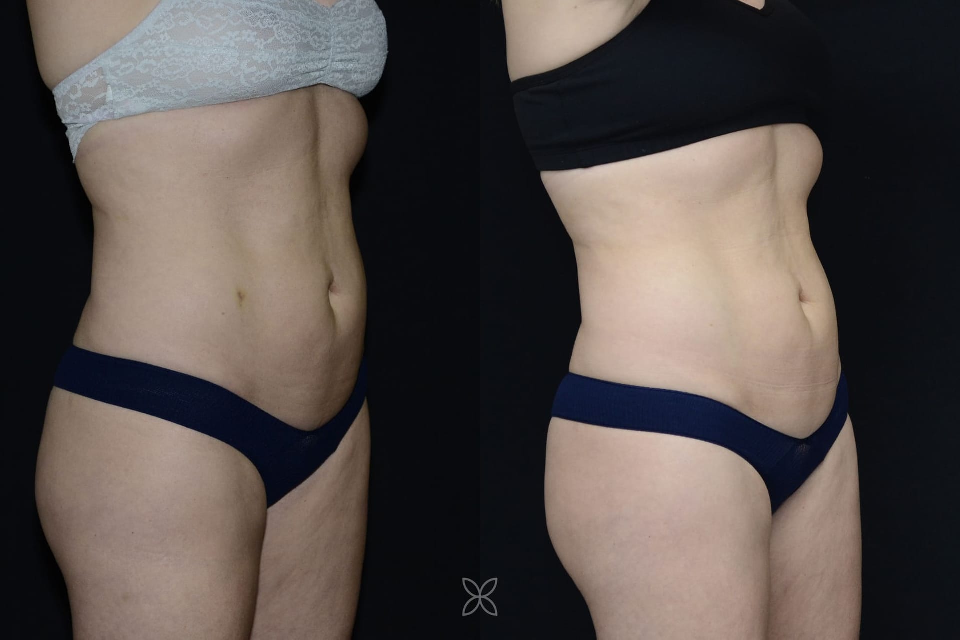 Emsculpt abdomen results - before and after