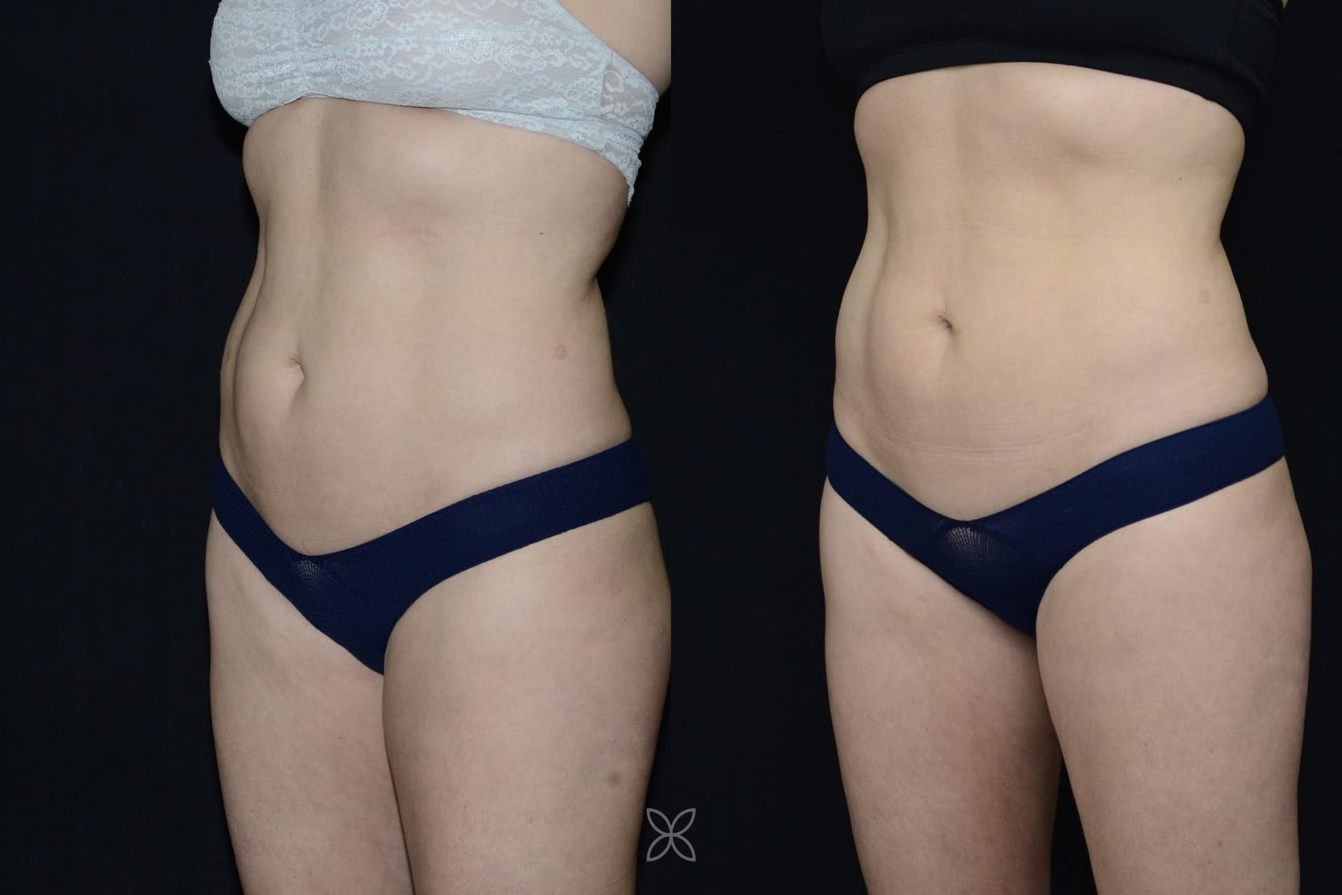 Emsculpt abdomen results - before and after