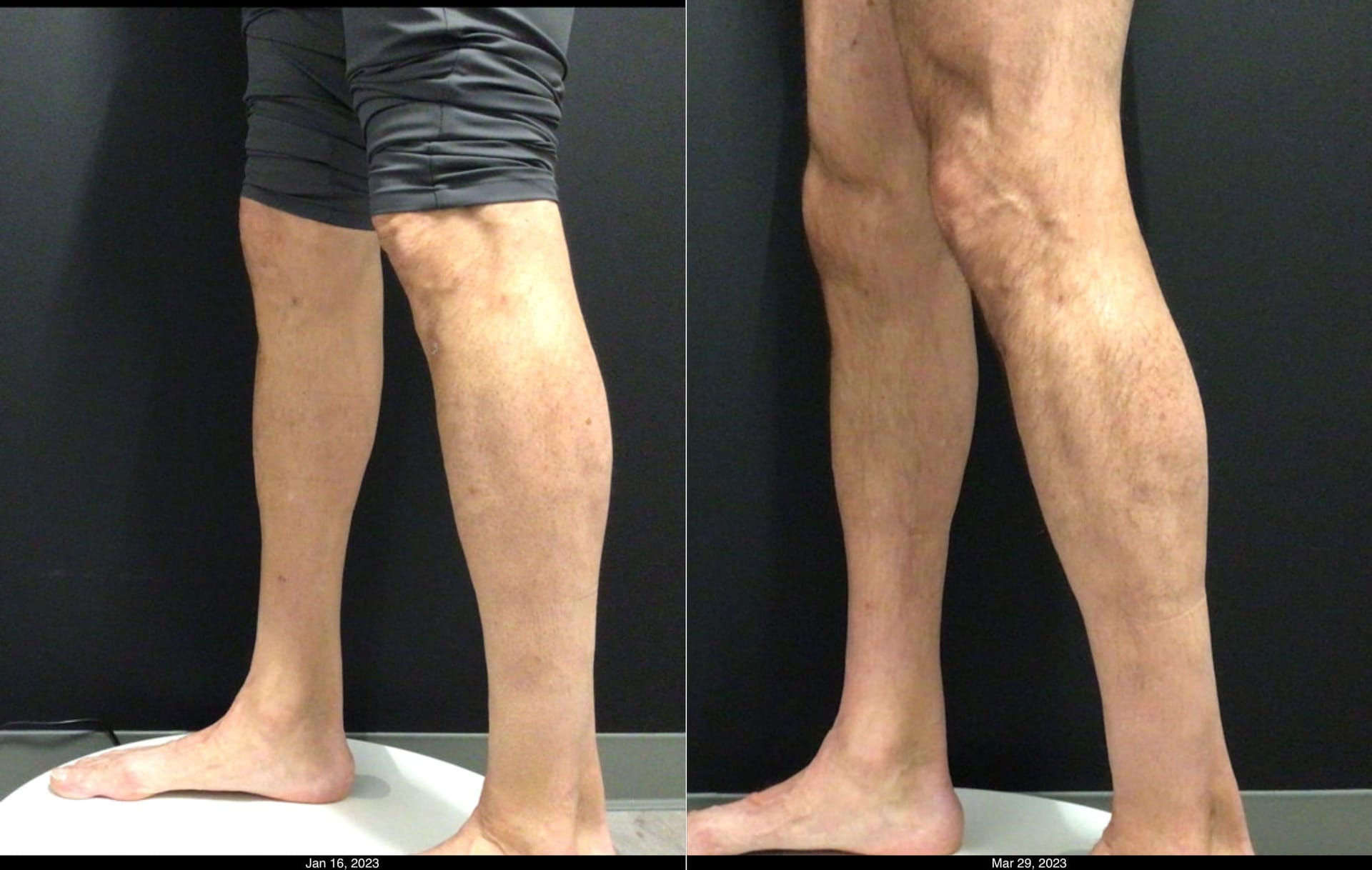 Emsculpt calves transformation - before and after