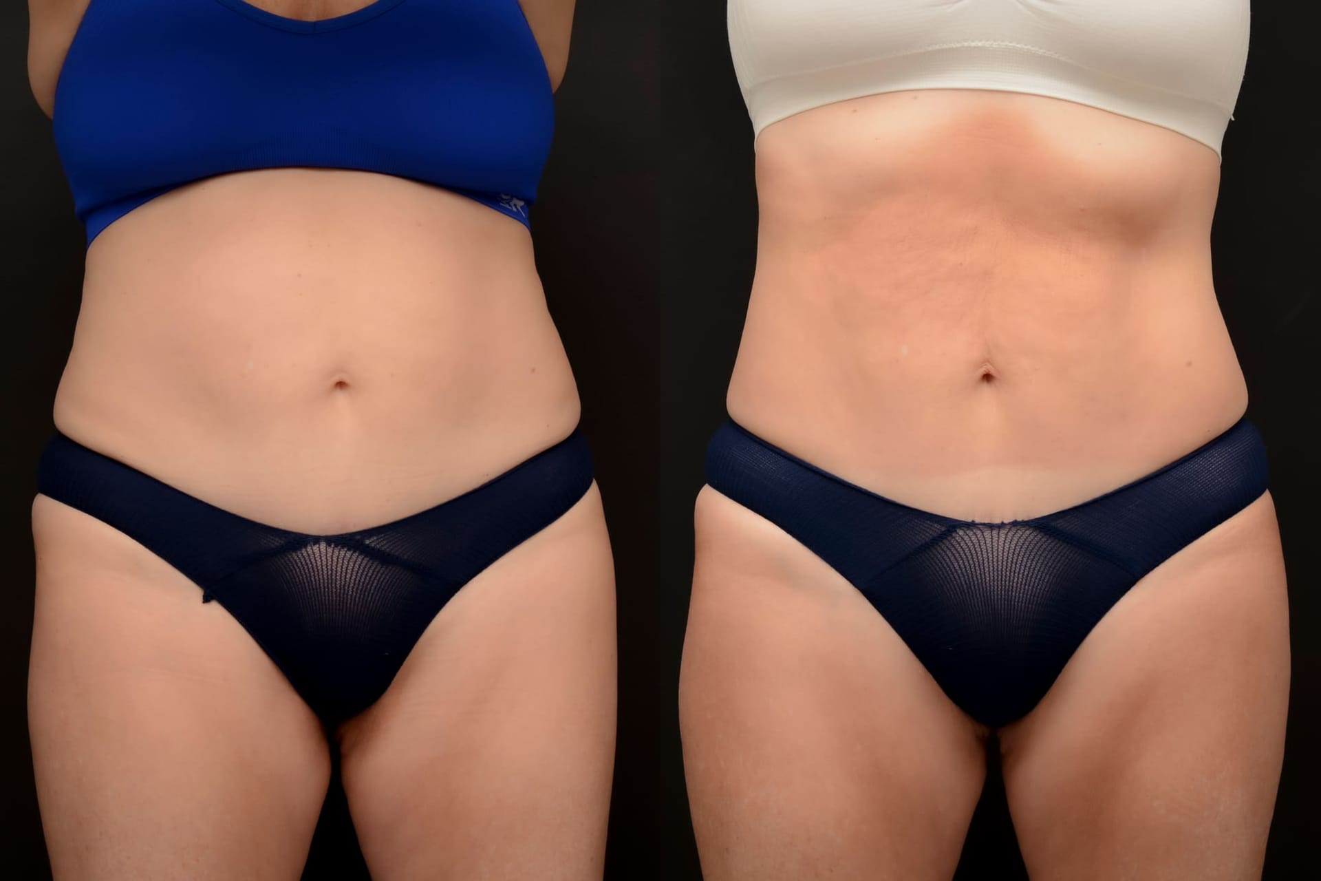 Emsculpt abdomen transformation - before and after
