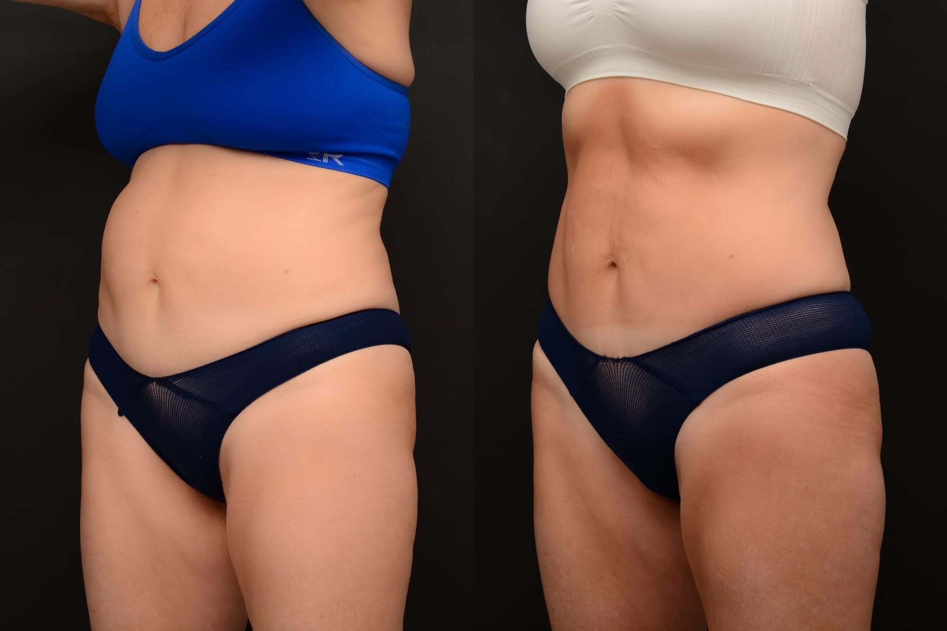Emsculpt abdomen transformation - before and after