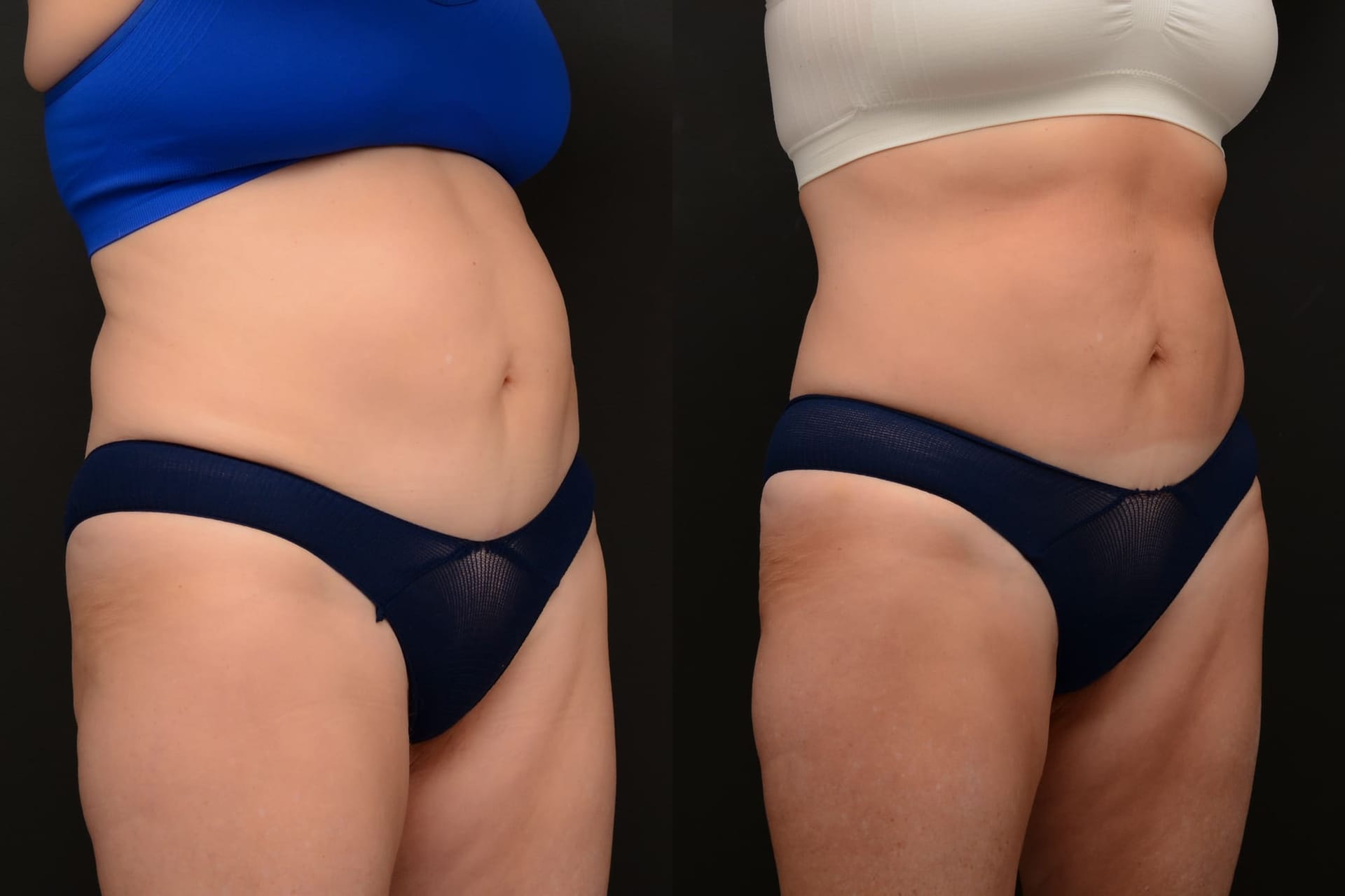 Emsculpt abdomen transformation - before and after