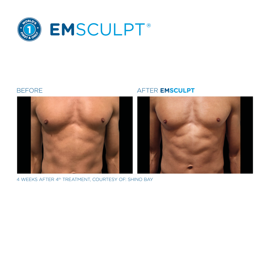 Abdominal Sculpting
