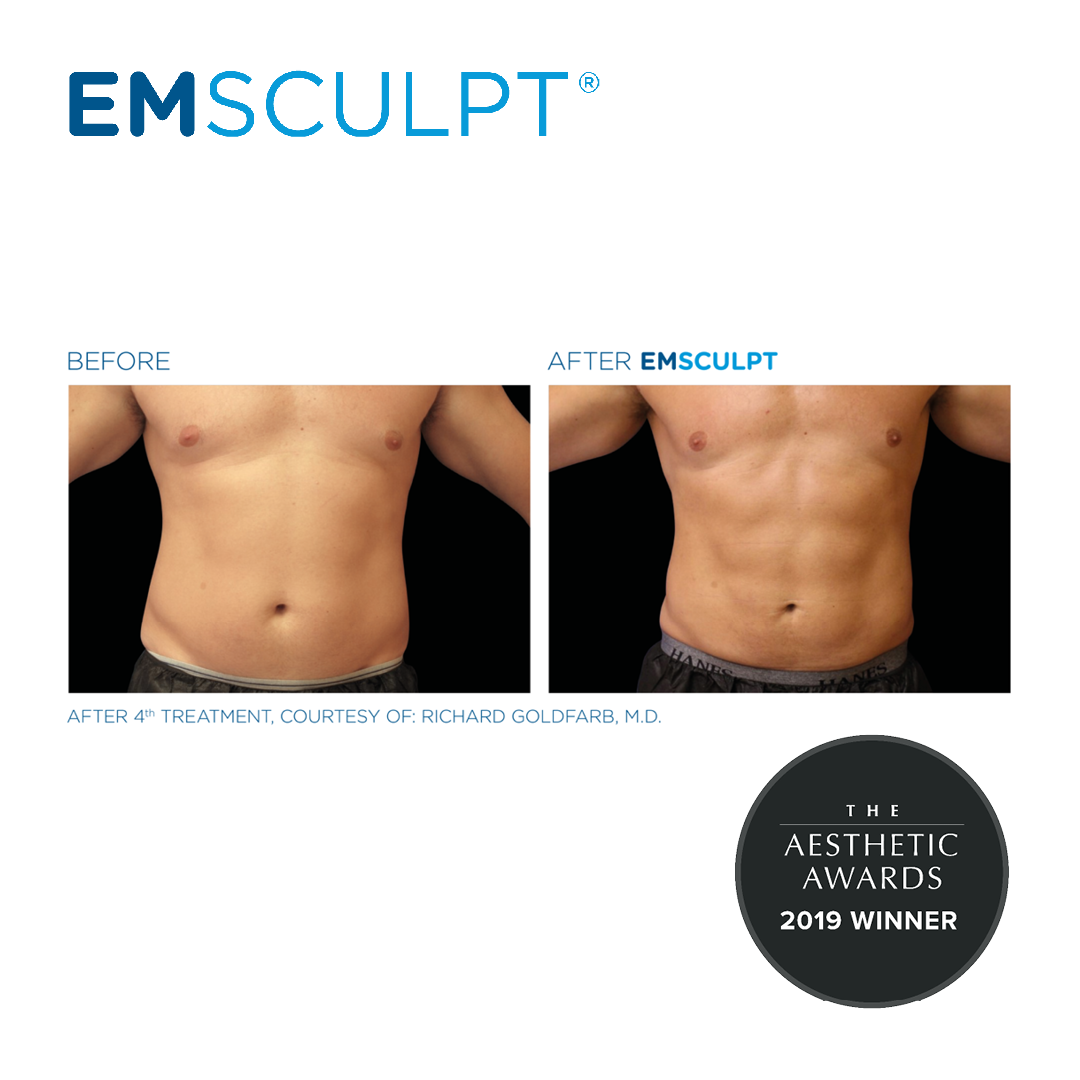 Abdominal Sculpting After Treatment 2