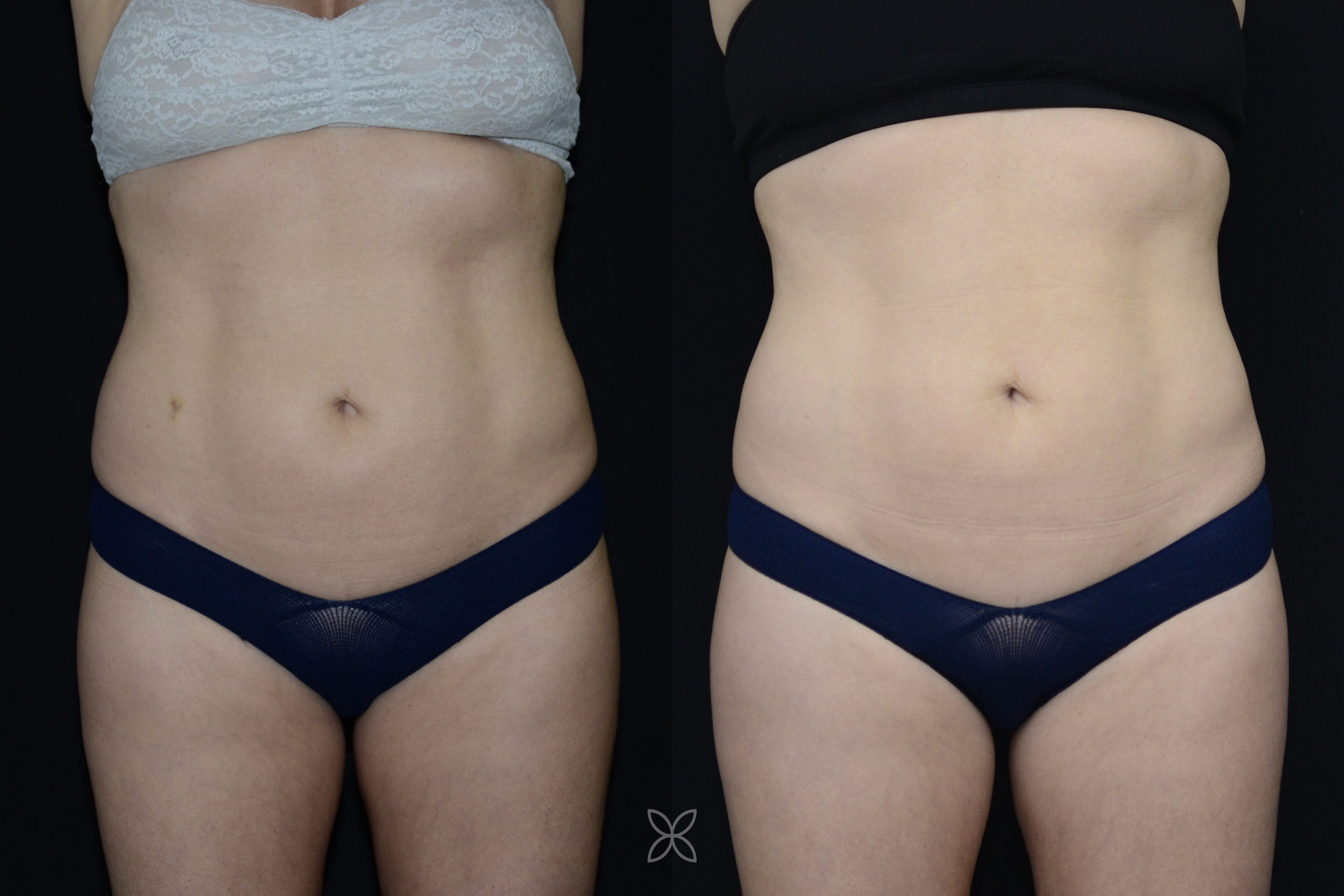 Emsculpt abdomen results - before and after