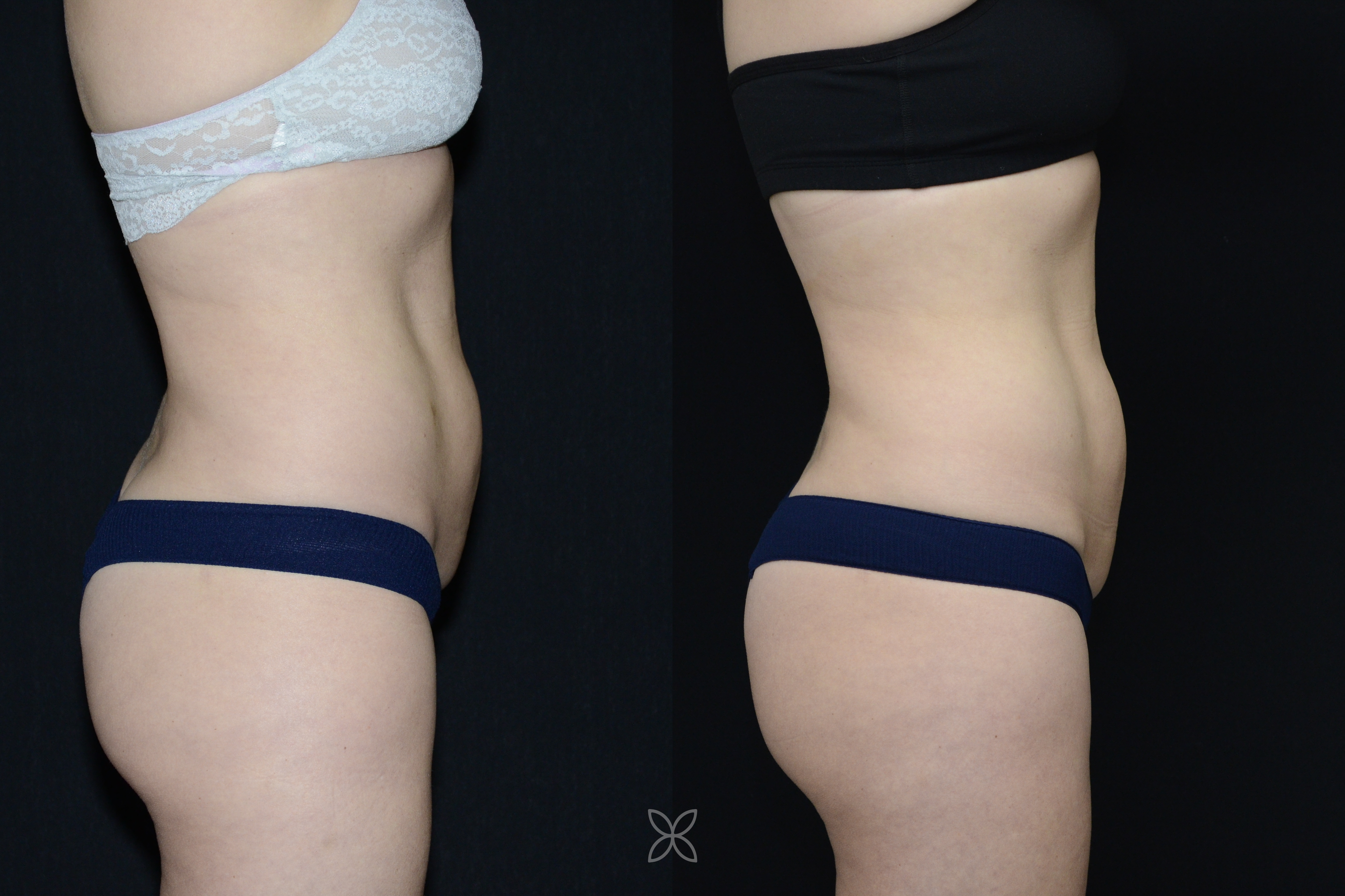 Emsculpt abdomen results - before and after