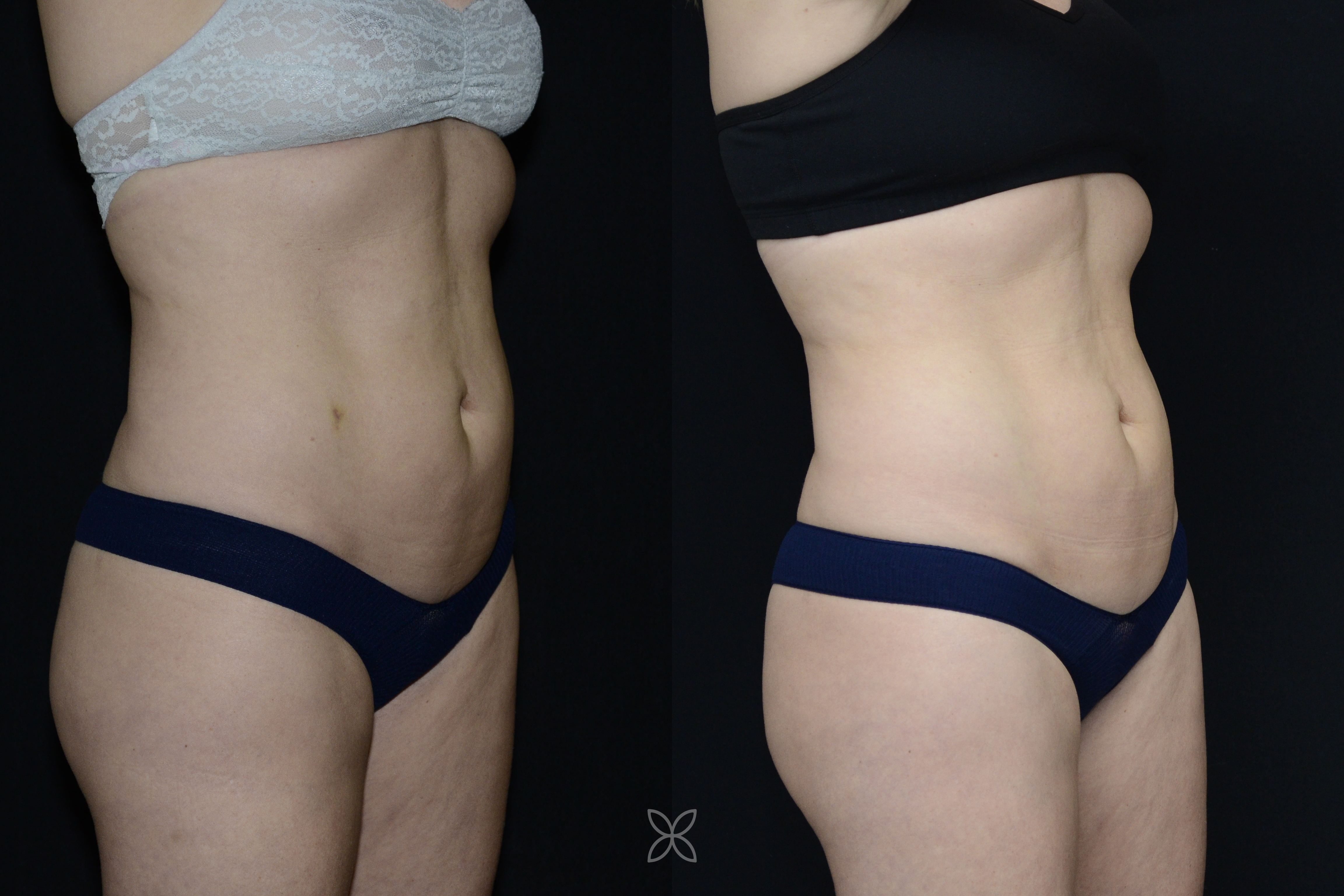 Emsculpt abdomen results - before and after