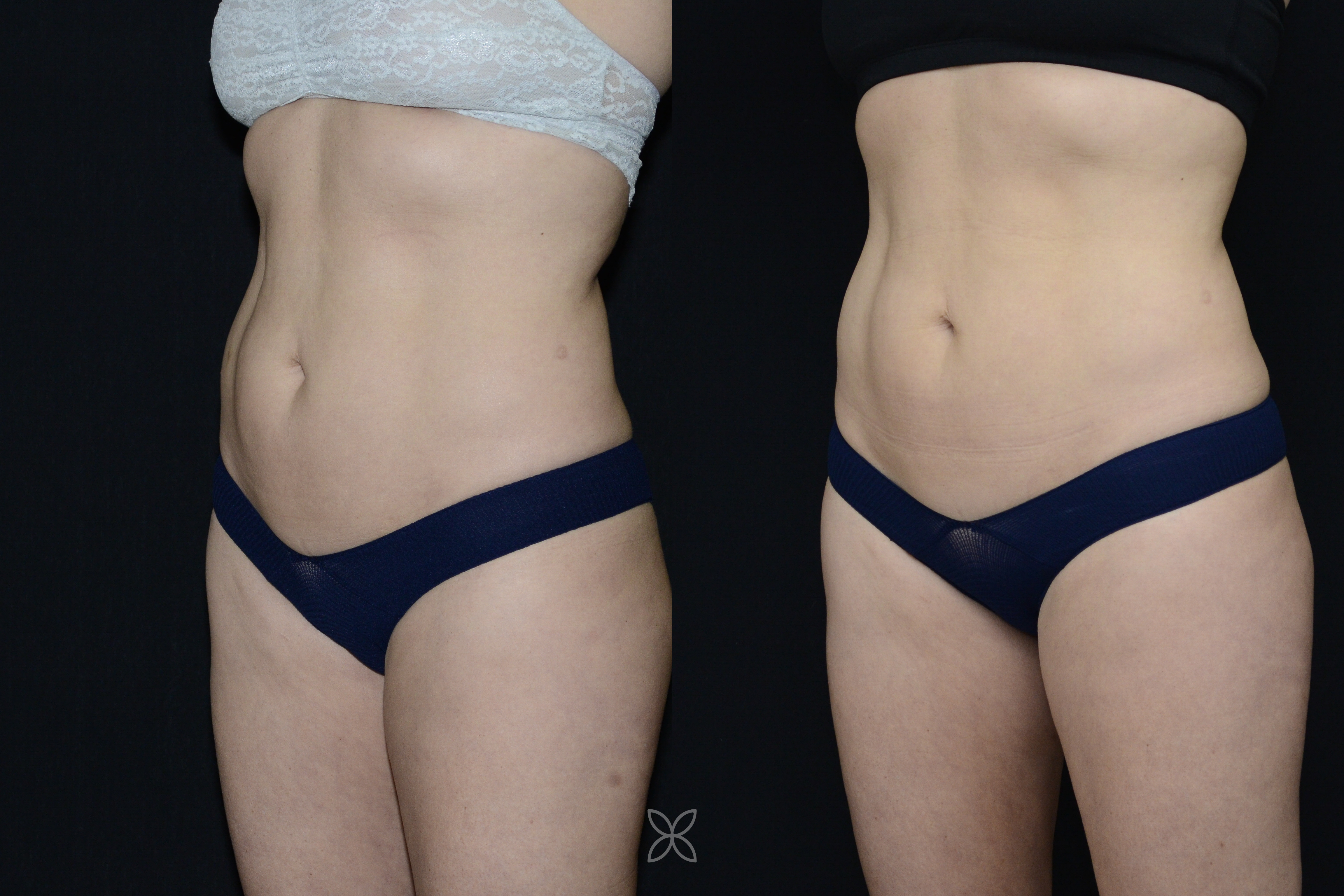 Emsculpt abdomen results - before and after