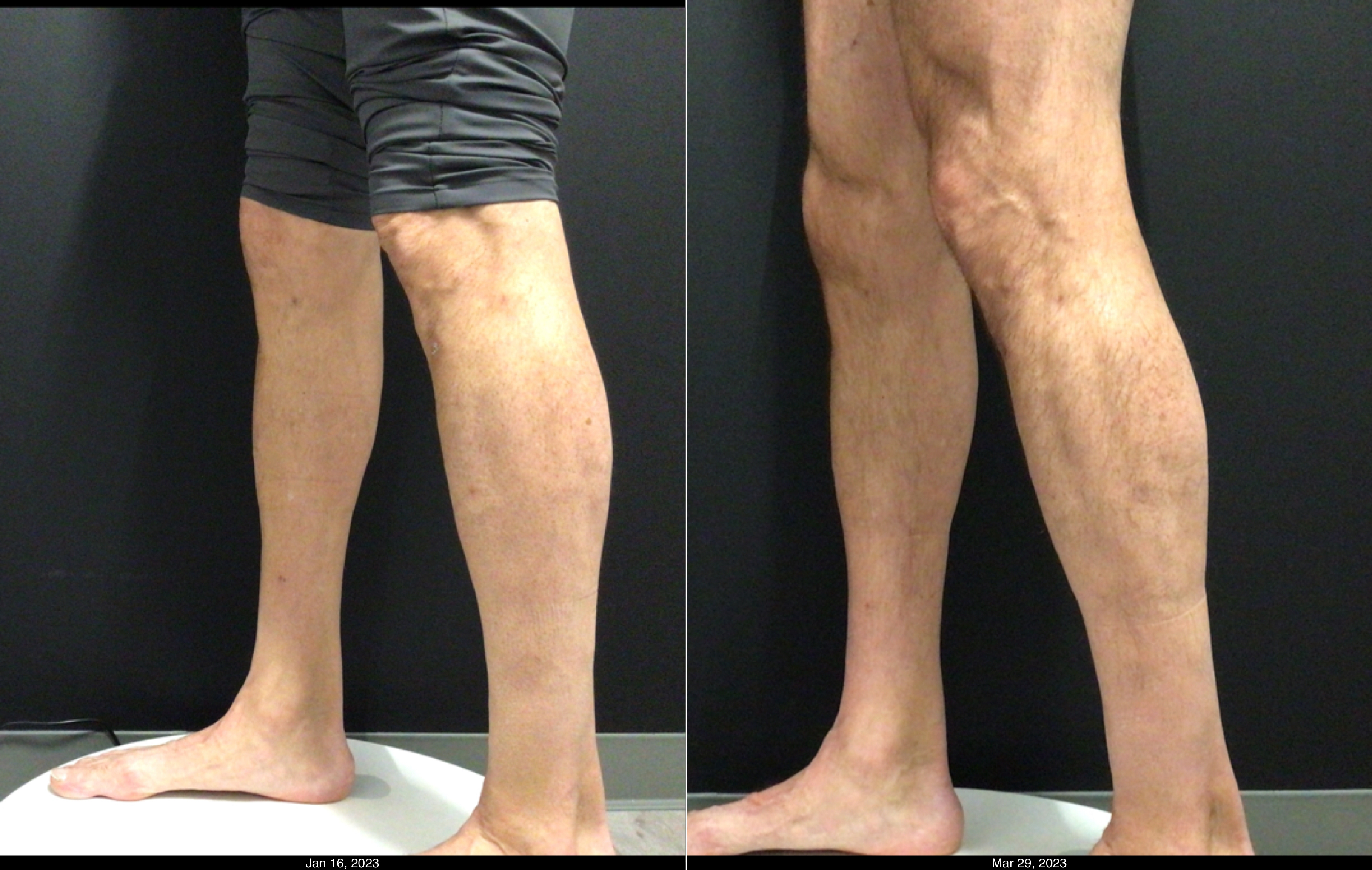Emsculpt calves transformation - before and after