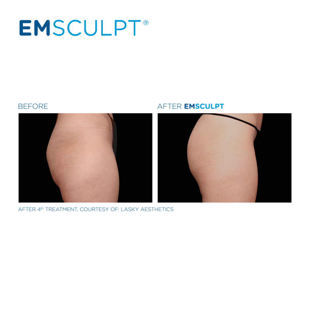 Emsculpt buttocks enhancement - before and after